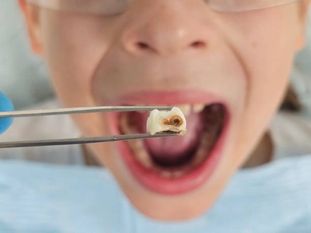 Best Emergency Dental Care for Broken or Chipped Teeth in St James, NC