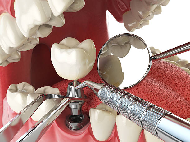 Best Emergency Tooth Extraction in St James, NC